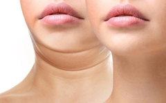 Hút mỡ nọng cằm