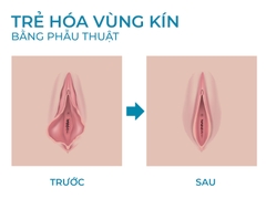 Thu hẹp âm đạo