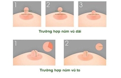 Thu nhỏ núm vú
