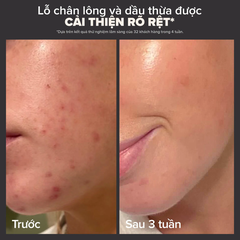 2% BHA Liquid Exfoliant/ TẨY TẾ BÀO CHẾT DÀNH CHO DA DẦU- HỖN HỢP