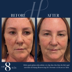 HYDRINITY Renewing HA Serum: Bí Quyết Trẻ Hóa Da Tức Thì Với HA "Siêu Tăng Áp"