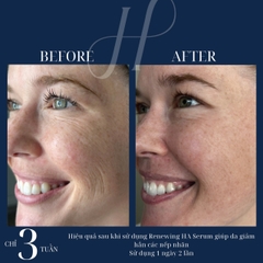 HYDRINITY Renewing HA Serum: Bí Quyết Trẻ Hóa Da Tức Thì Với HA "Siêu Tăng Áp"