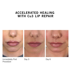Neova CU3 Lip Repair: Son Dưỡng Môi Phục Hồi Chuyên Sâu với Đồng Peptide