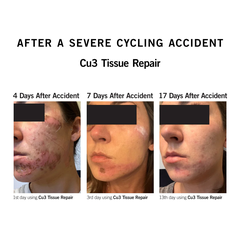Neova CU3 Tissue Repair – Kem Phục Hồi Da Sau Laser, Meso, Bỏng