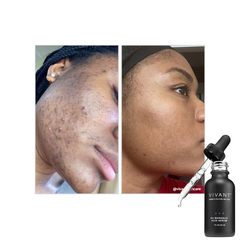 Vivant Skincare 8% Mandelic Acid - Serum Tái Tạo Da Chuyên Sâu Cho Làn Da Sáng Mịn, Sạch Mụn Chuẩn Y Khoa