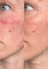 THERAMID CERAMIDE TREATMENT - Phức Hợp Phục Hồi Với Ceramide Nồng Độ Tăng Cường: Chìa Khóa Vàng Cho Làn Da Khỏe Mạnh, Mịn Màng