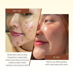 Acne Serum Ladeen 20ml