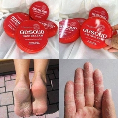 kem nứt gót glysoild