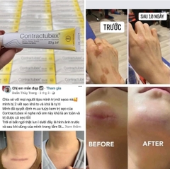 Gel trị sẹo Contractubex 20g
