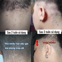 Dầu Gội Canova Rivescal DS 200ml – Giảm Viêm Da Đầu, Nấm Gàu, Mụn Đỏ, Viêm Da Tiết Bã, Làm Dịu Da Đầu, Kiểm Soát Nhờn Hiệu Quả
