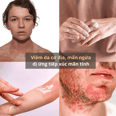 Kem dưỡng ẩm Latopic Probiotic Emollient Active Face And Body Cream giảm viêm da cơ địa, chàm sữa, làm dịu ngứa da dị ứng, kích ứng da, giảm khô da (75ml)