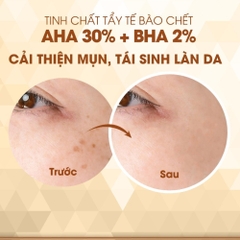 Tinh chất tẩy tế bào chết Care:Nel AHA BHA làm sạch da, cân bằng độ PH, giảm mụn đầu đen 30ml
