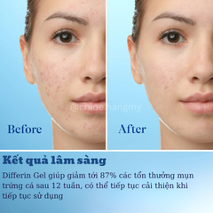 Gel trị mụn Differin Adapalene 0,1% hỗ trợ mụn mờ thâm bản Mỹ tuýp 15g