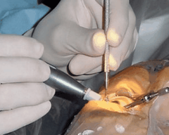 Dịch vụ Điều trị Cận thị