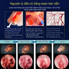 Máy Điều Trị Hỗ Trợ Viêm Mũi, Viêm Xoang Viêm Mũi Dị Ứng Bằng Sóng Hồng Ngoại Tặng Kèm Pin 9v