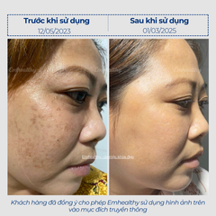 Combo 2 Chống nắng, hỗ trợ điều trị mụn và nám, phục hồi toàn diện tại nhà | Có HLV đồng hành 3 tháng