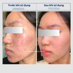 Combo 4 Hỗ Trợ Điều Trị Mụn, Nám & Phục Hồi Nền Da tại nhà | Có HLV đồng hành 3 tháng
