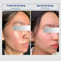 Vi sinh 2.7 dành cho da thường| Mỹ phẩm vi sinh Hoa Ngân