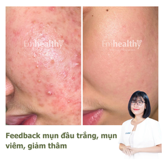 Gói Hỗ Trợ Điều Trị Mụn và Kiểm Soát Dầu 1 - 3 tháng| Dành cho da dày, khỏe (có chuyên viên theo dõi 1:1)