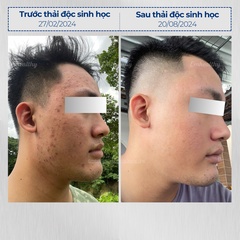 Vi sinh 2.7 dành cho da thường| Mỹ phẩm vi sinh Hoa Ngân