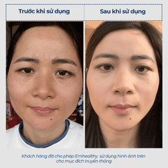 Vi sinh 2.7 dành cho da thường| Mỹ phẩm vi sinh Hoa Ngân