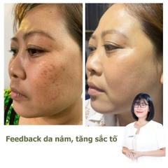 Gói Hỗ Trợ Điều Trị Nám 1 - 3 tháng| Dành cho da dày khoẻ (HLV làn da đồng hành 1:1)