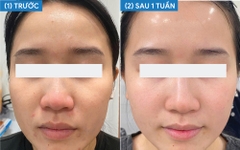 Xịt dưỡng Miracle Essence | Mỹ phẩm vi sinh Hoa Ngân