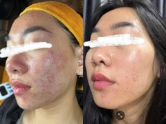 peel REDNESS