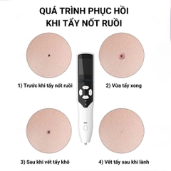 Máy Plasma Nhấn Mí TH COMPANY, Máy Đốt Nốt Ruồi Mụn Thịt Nám Tàn Nhang Có Tích Điện
