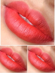 CẤY MÔI SINH HỌC (BIO LIP INFUSION)