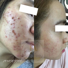 Điều trị da mụn cơ bản