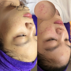 Điều trị da mụn cơ bản