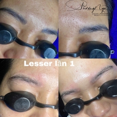 Hút - xóa chân mài bằng Lasser