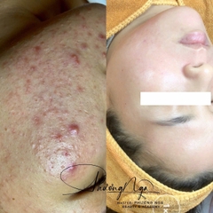Điều trị mụn chuyên sâu