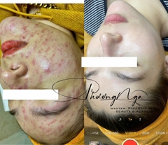 Điều trị mụn chuyên sâu