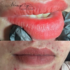 Khử thâm môi kết hợp ủ dưỡng (Detox + Collagen)