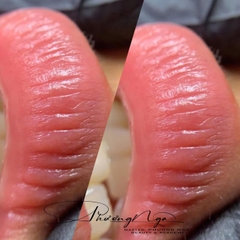 CẤY MÔI SINH HỌC (BIO LIP INFUSION)