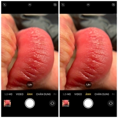 CẤY MÔI SINH HỌC (BIO LIP INFUSION)