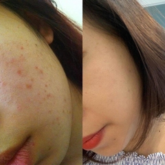 [FREE SHIP] Serum The Ordinary Mờ Thâm Mụn Sáng Da NIACINAMIDE 10% + Zinc