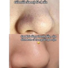 [ILSO] Cây Nặn Mụn Đầu Đen ILSO chuyên dụng Deep Clean Master giúp đẩy & lấy mụn đầu đen dễ dàng