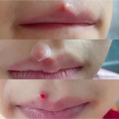 [FOCALLURE] Miếng Dán Mụn FOCALLURE Siêu Mỏng Trong Suốt Không Thấm Nước, Hỗ Trợ Giảm Sưng Viêm 24 miếng (FA186)
