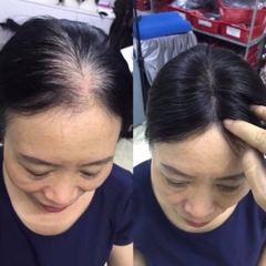 Tóc Giả Phủ Hói Phủ Bạc Đỉnh Đầu Không Mái 4D Cao Cấp – Mái Che Đỉnh Tự Nhiên, Tơ Mềm Như Tóc Thật, Kẹp Chắc Không Lộ
