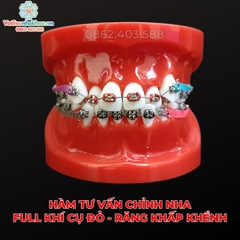 Hàm tư vấn chỉnh nha full khí cụ đỏ - Răng khấp khểnh