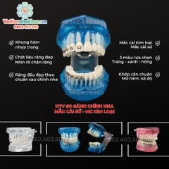 Hàm tư vấn so sánh chỉnh nha mắc cài sứ và kim loại
