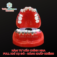 Hàm tư vấn chỉnh nha full khí cụ đỏ - Răng khấp khểnh