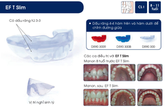 Hàm định hình khớp răng EF Line Orthoplus