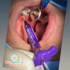 MTA trám bít ống tủy Endocem MTA - Maruchi