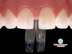 Bộ matrix hàn tam giác đen và khe thưa (matric)