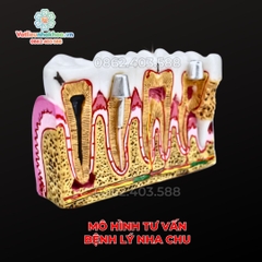 Mô hình tư vấn bệnh lý nha chu