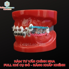 Hàm tư vấn chỉnh nha full khí cụ đỏ - Răng khấp khểnh